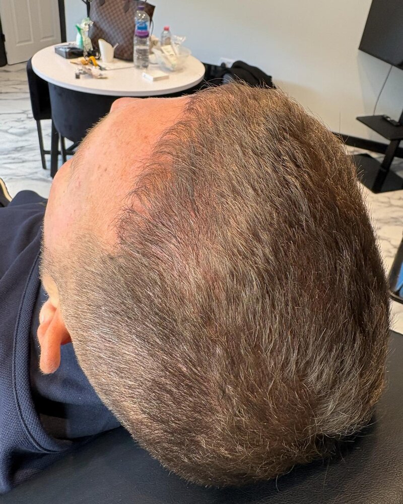 After: PRP hair restoration, real client results at Rejuven8