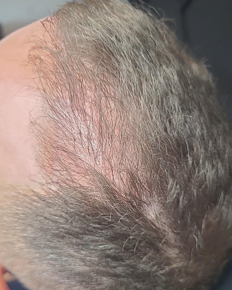 Before: PRP hair restoration, real client results at Rejuven8